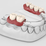 What Are The Steps To Getting A Dental Bridge?