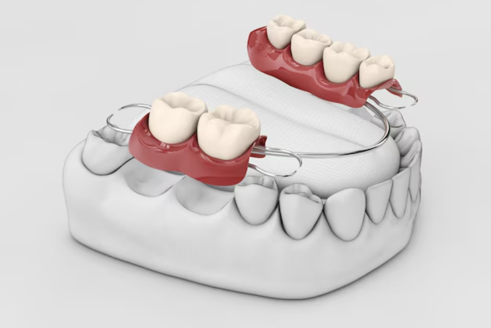 What Are The Steps To Getting A Dental Bridge?